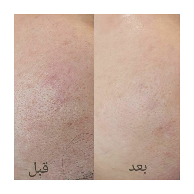 میکرودرم خانگی لومی تک مدل fd-33