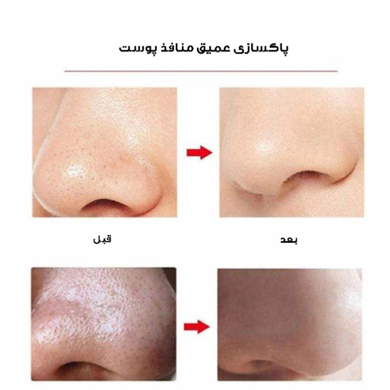 میکرودرم گلویش استایل مدل HY803 به همراه ست پاکسازی صورت بسته 5 عددی