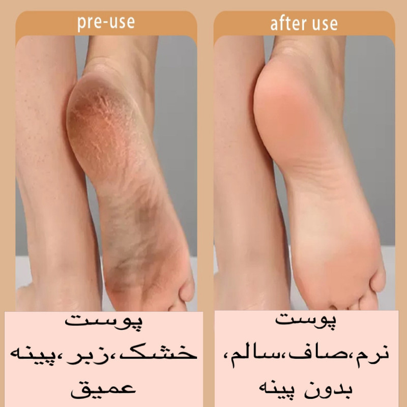 سنگ پا برقی مدل CALLUS REMOVER